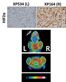 Interrogating HIF2α with novel molecular probe.</strong> PET tracer reads out HIF2α in patient kidney tumors transplanted in mice.