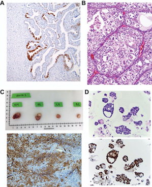 A) p53 stain demonstrating a p53 signature in a Li Fraumeni fallopian tube, B) expertise in the pathobiology of clear cell ovarian carcinoma (Dr. Oliva) shown here with an H&E image of a clear cell carcinoma, and C) expertise in the study of mechanisms of treatment-induced resistance in ovarian cancer using mouse in vitro and in vivo ovarian cancer models (Dr. Rueda). Shown above are gross (top) and IHC (bottom) images of ovarian tumors from a PDX model post treatment from Dr. Ruedas lab. There is also expertise in D) organoid modeling of ovarian cancer to study mechanisms of drug response and resistance (Dr. Hill) shown here with an H&E (top) and p53 stain (bottom) of sections of high grade serous ovarian cancer organoids from her lab